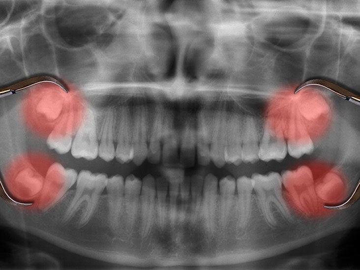 wisdom tooth extraction