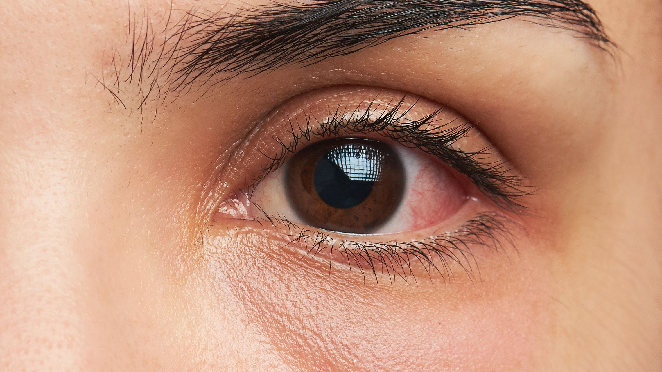 Under-Eye Swelling (Puffy Eyes): Causes, treatment, and more