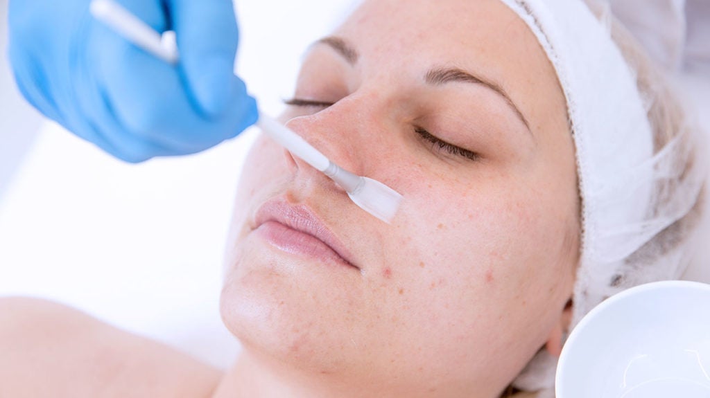The Peel Deal - The Risks And The Benefits Of Chemical Skin Peels