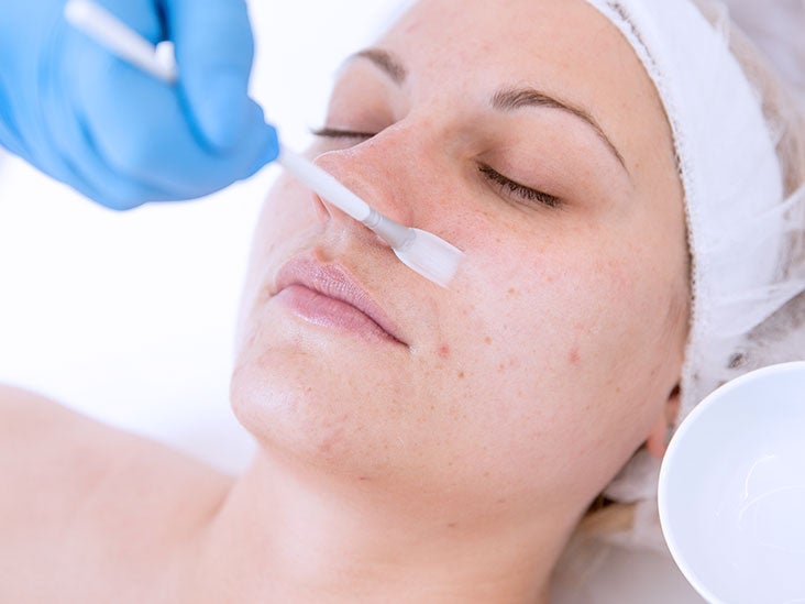 Why does Chemical Skin Peel Work?