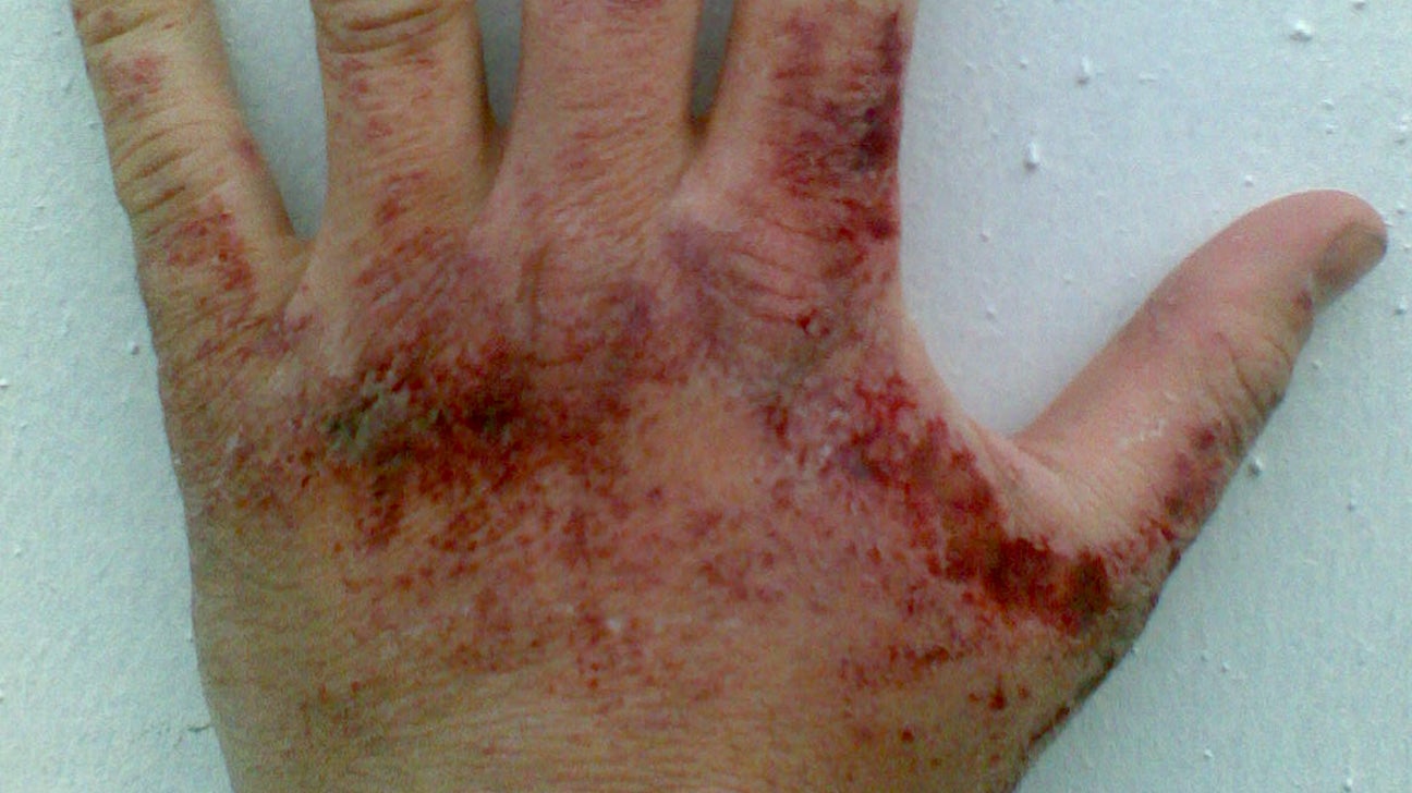 3rd degree burn scar hand