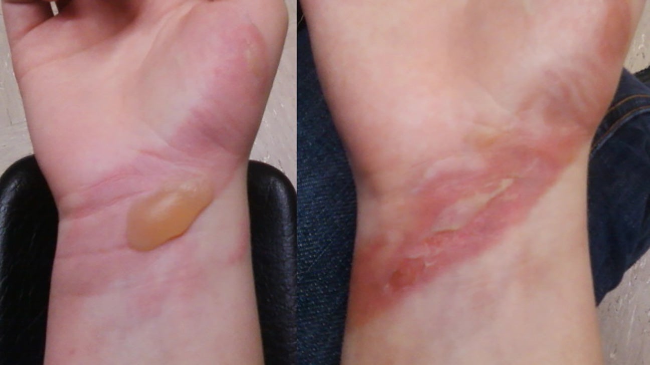 2nd-second-degree-burn-healing-process-pictures-go-images-club