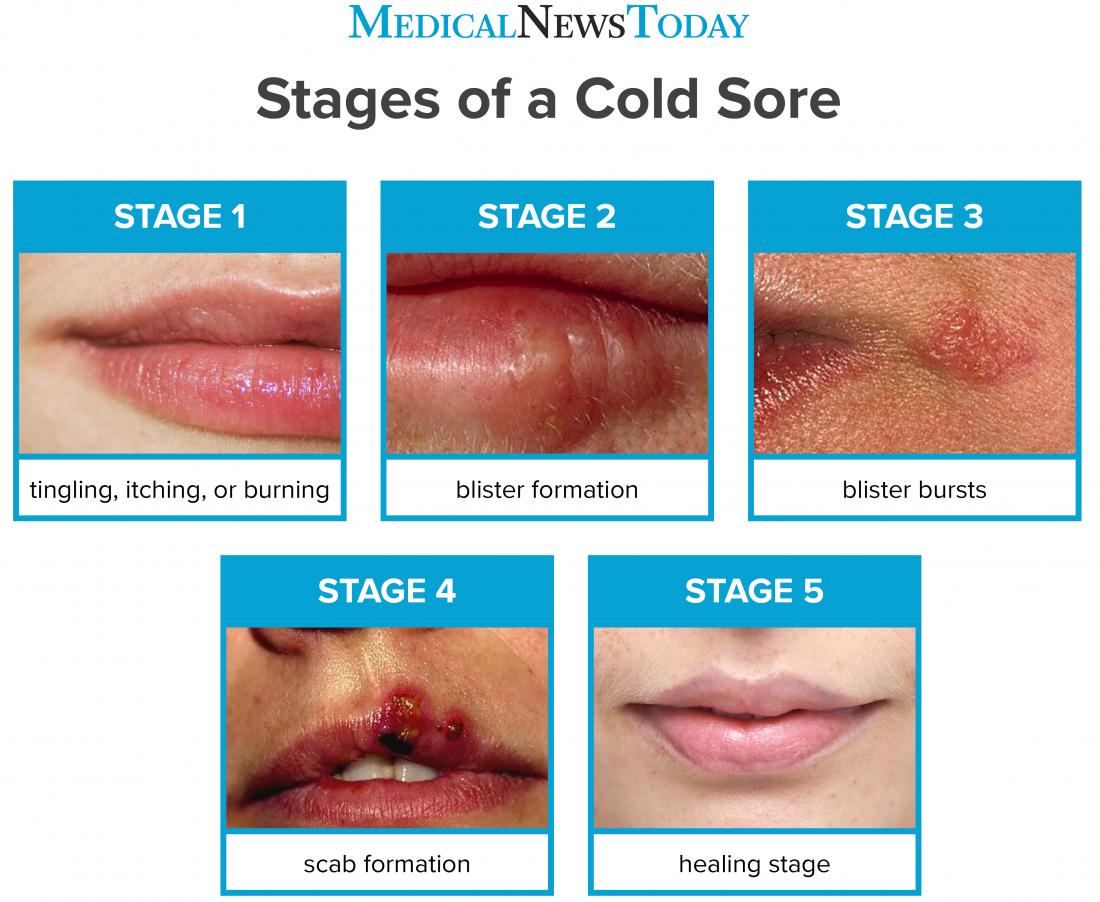 How long do cold sores last? Stages, pictures, and treatments