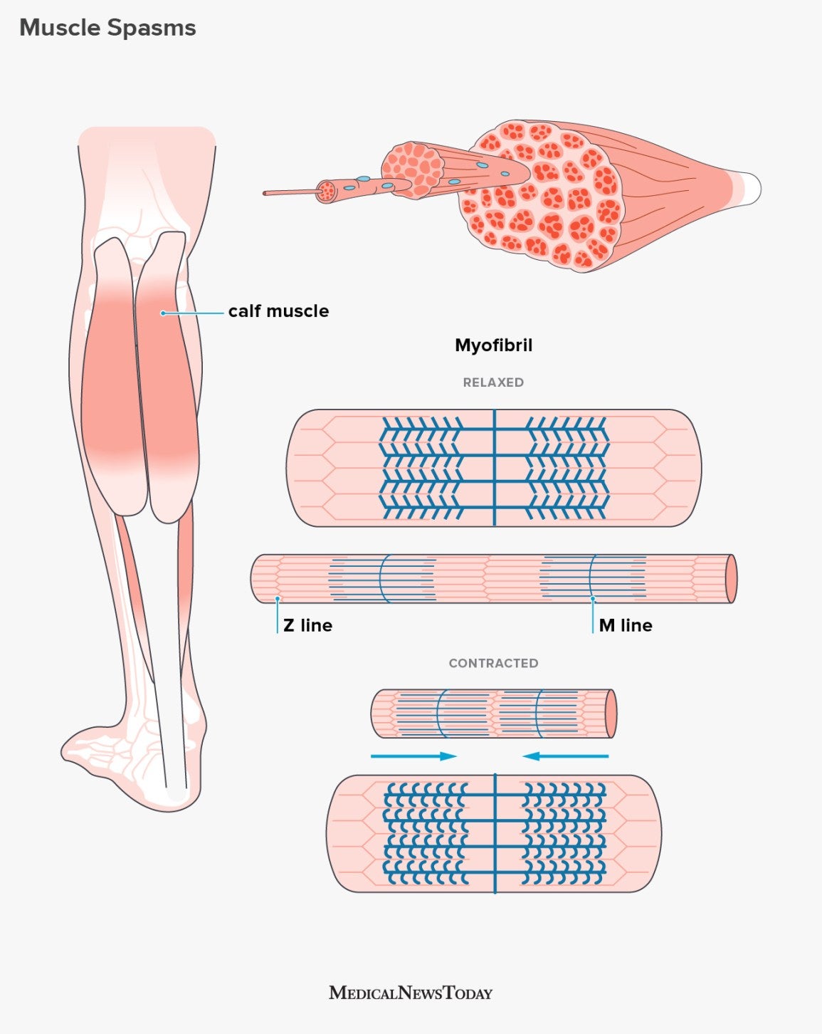 Muscle Spasms Causes Symptoms And Treatment