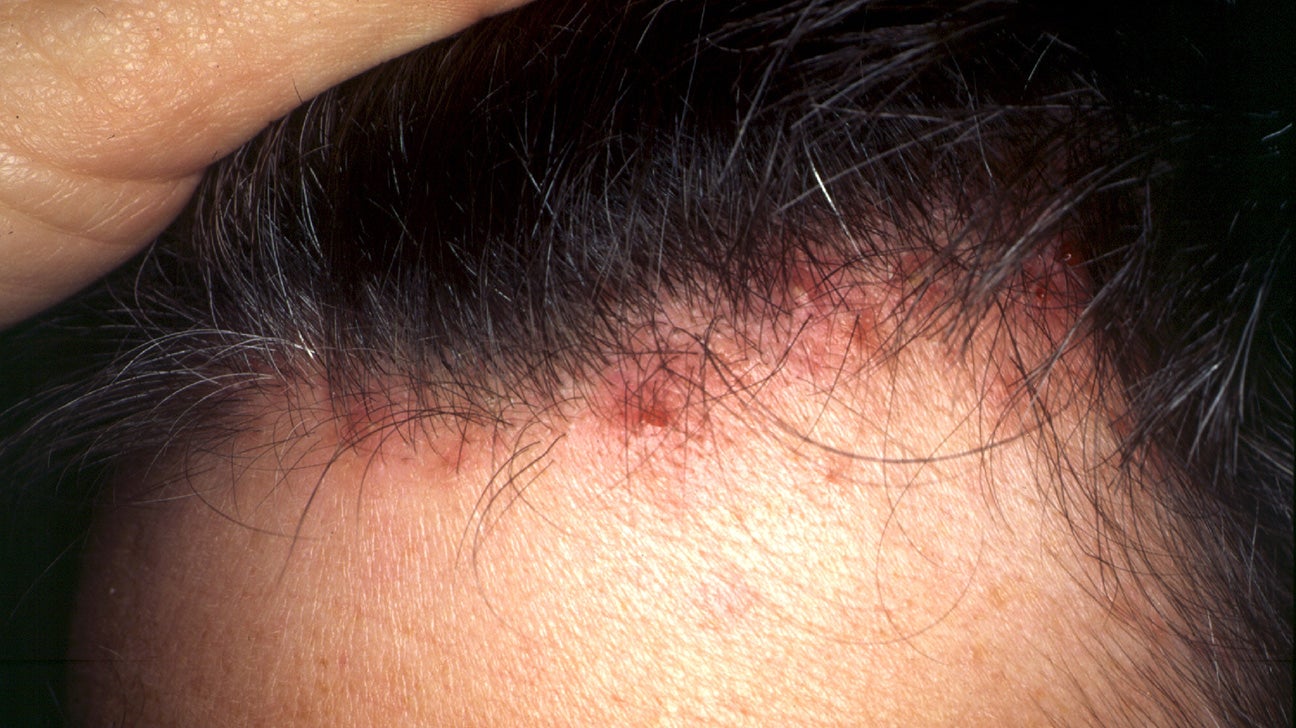 dry itchy scalp red spots