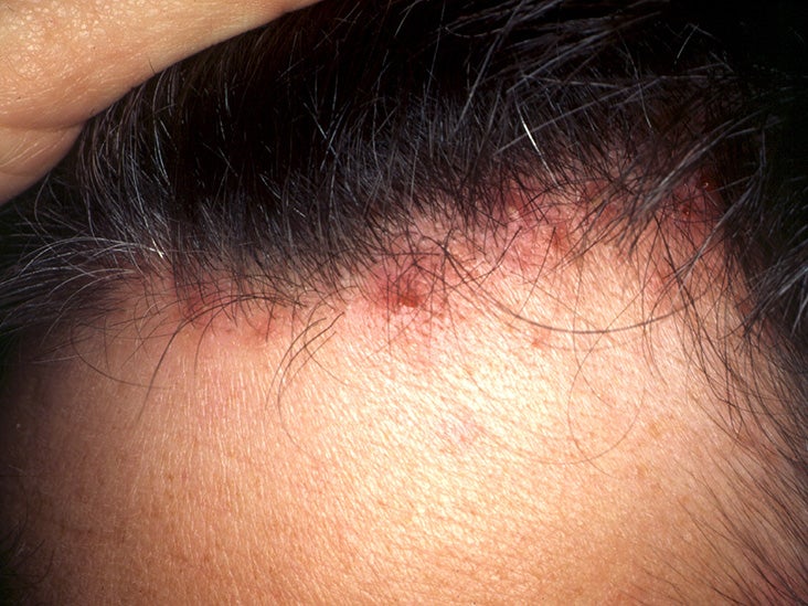 Scalp folliculitis: Symptoms, pictures, causes, shampoos and creams