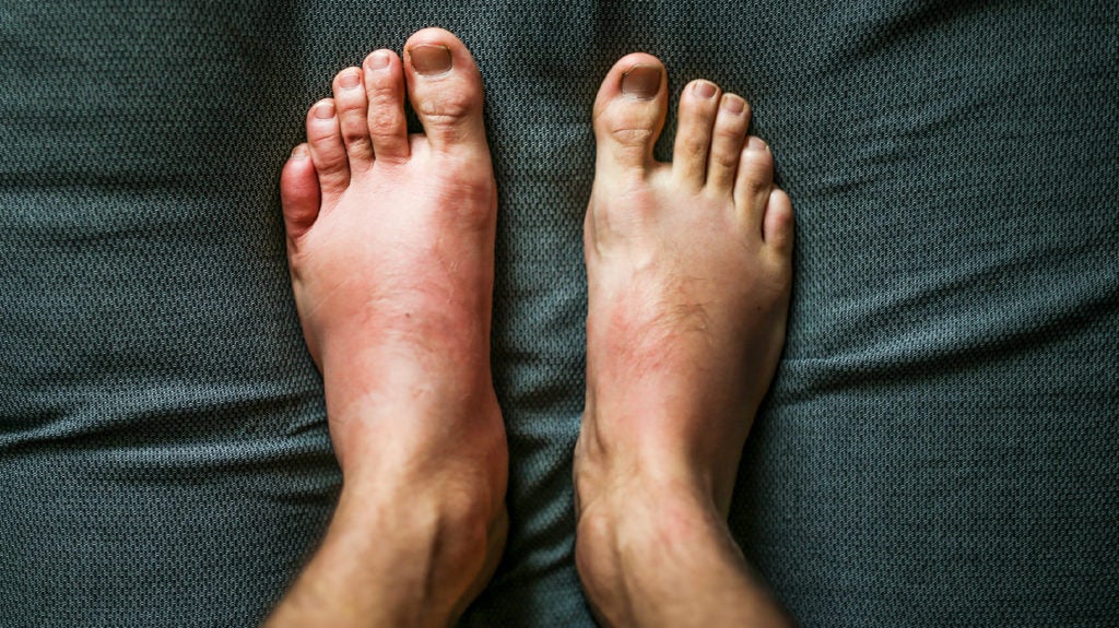 Why Are My Feet Swollen?