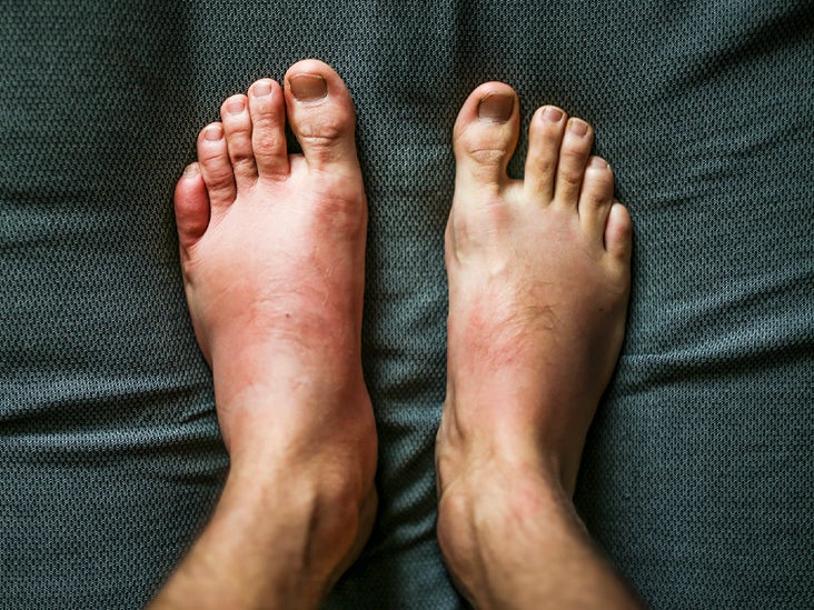 Edema In Feet