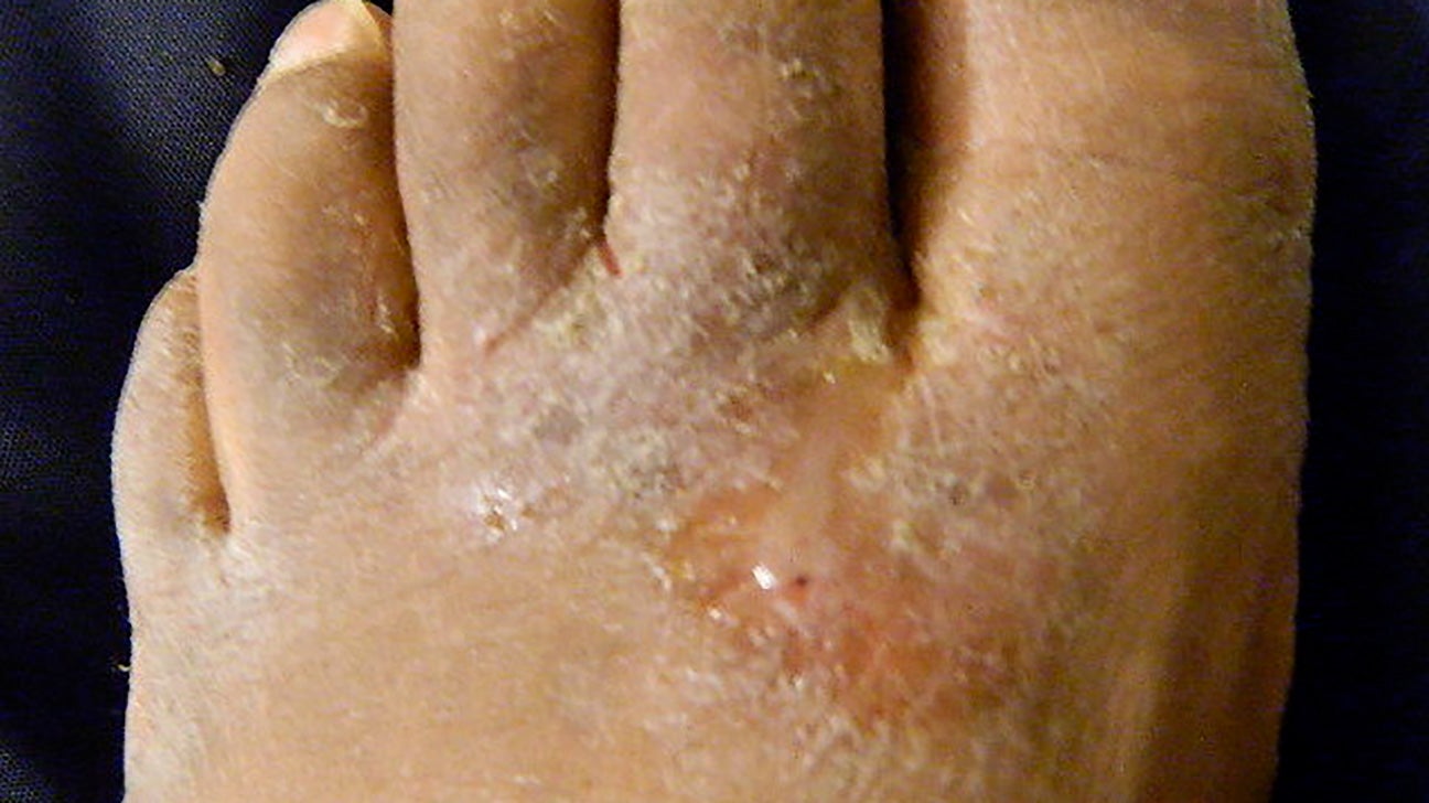 White Dry Skin On Toes