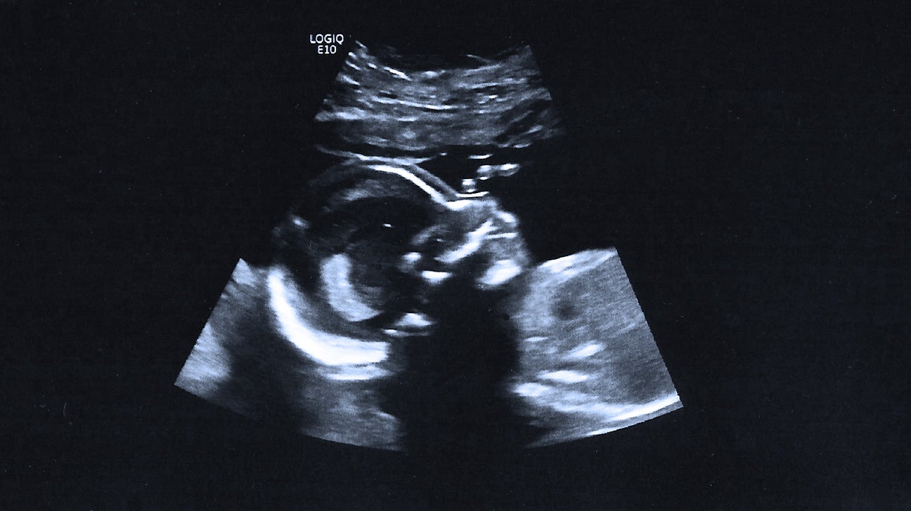 Weeks ultrasound at 4 Patience is