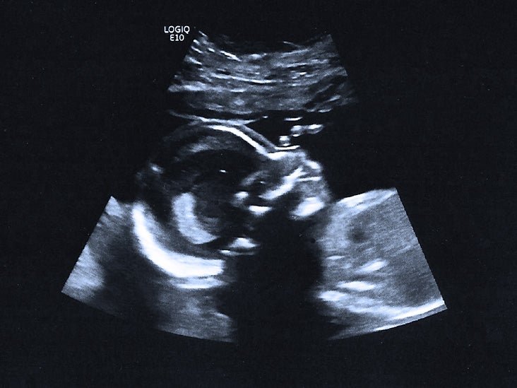 lidenskabelig fordel Vuggeviser 20-week ultrasound: Pictures, procedure, and more