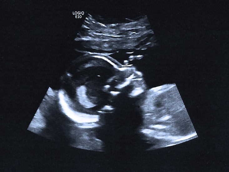 20 Weeks Pregnant With Twins Ultrasound