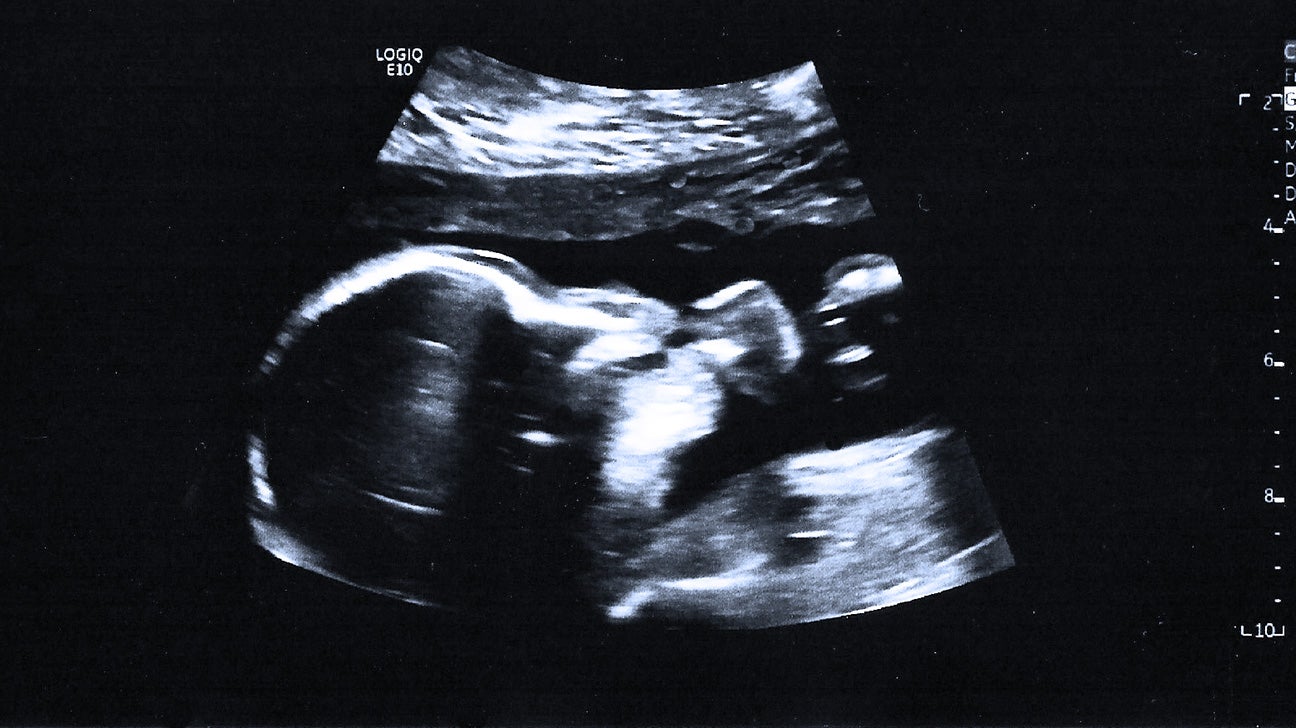 20 Weeks Ultrasound