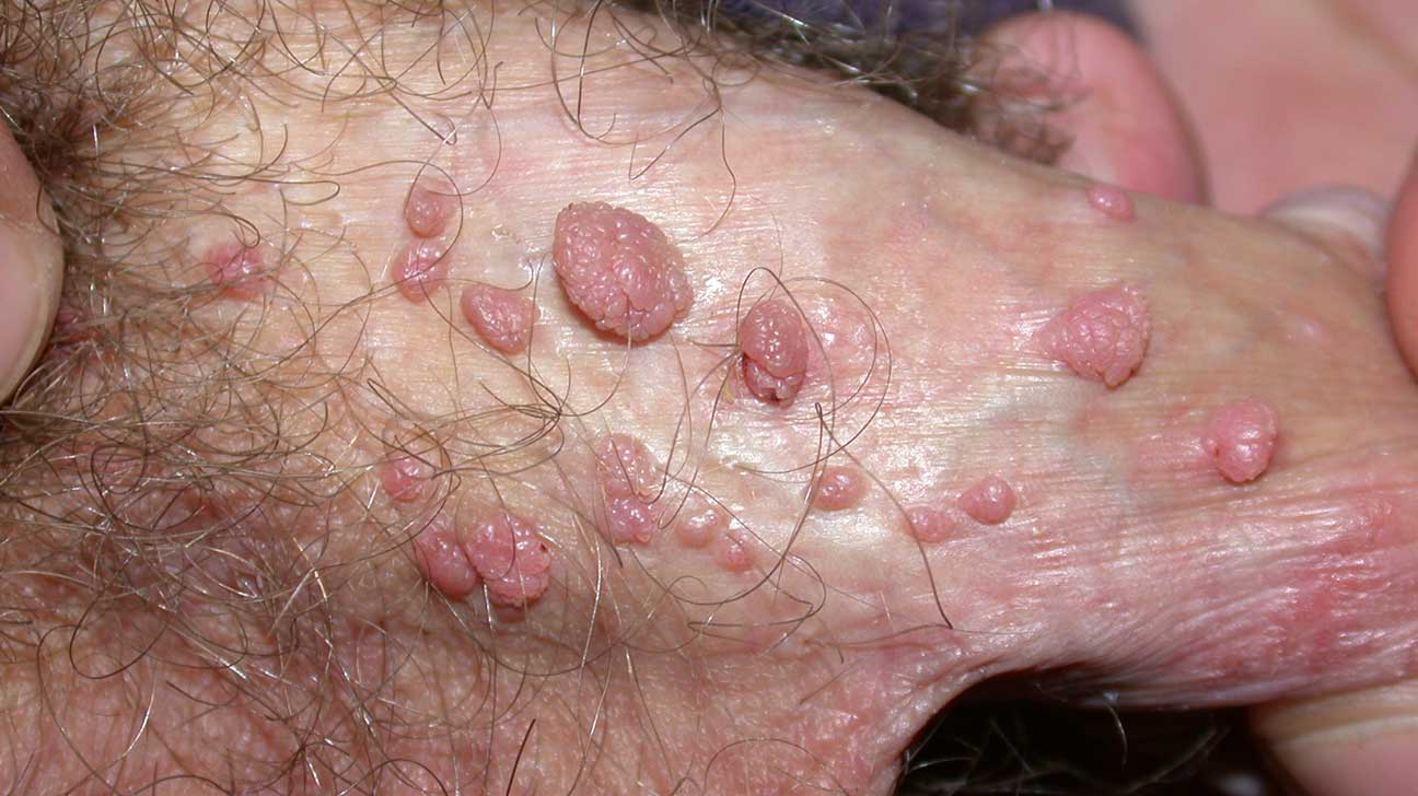 Skin tag on penis Causes diagnosis and treatment