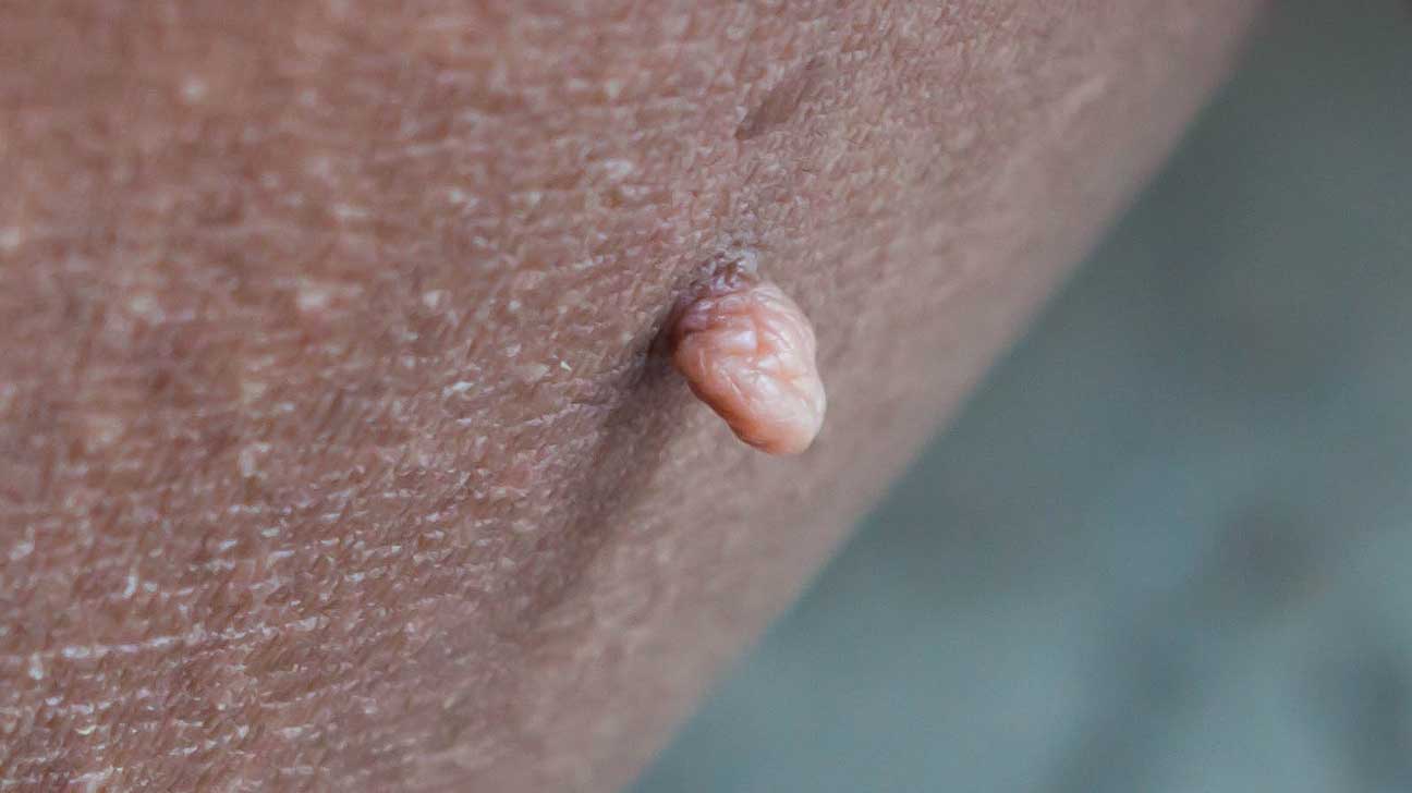 On raised penis mole Melanoma Pictures