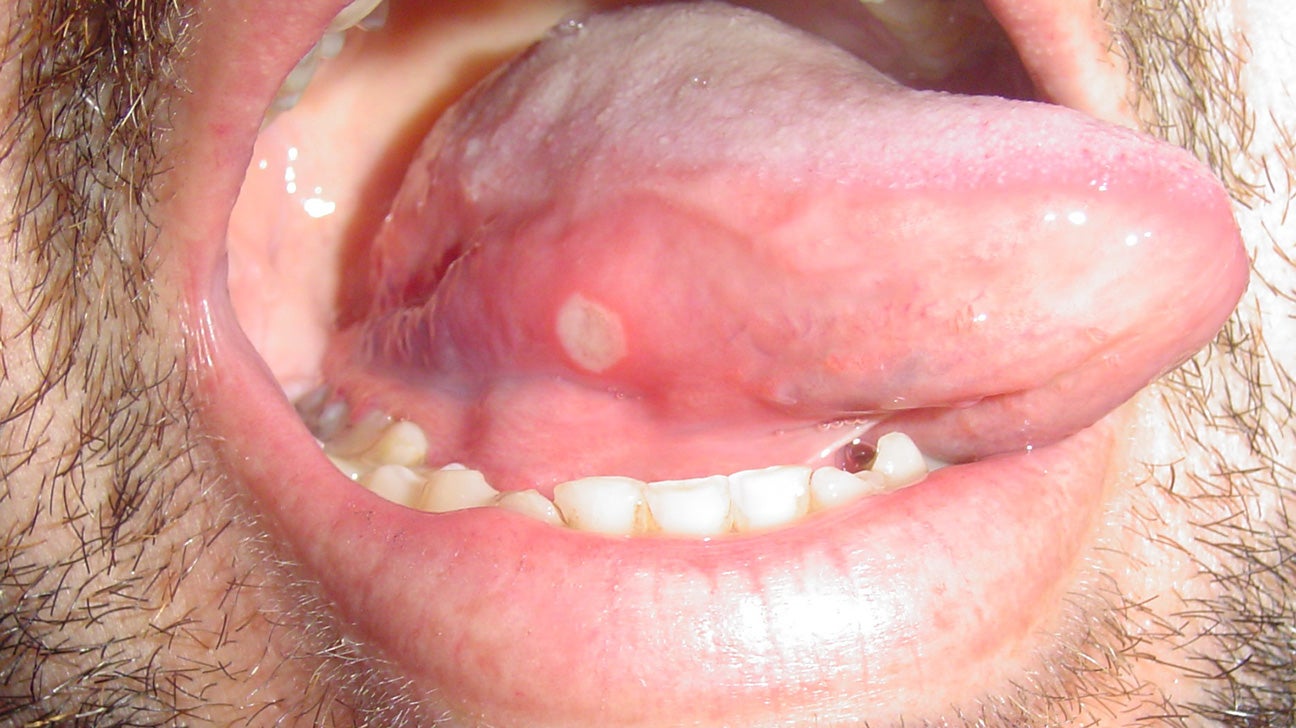 fever blister on tongue