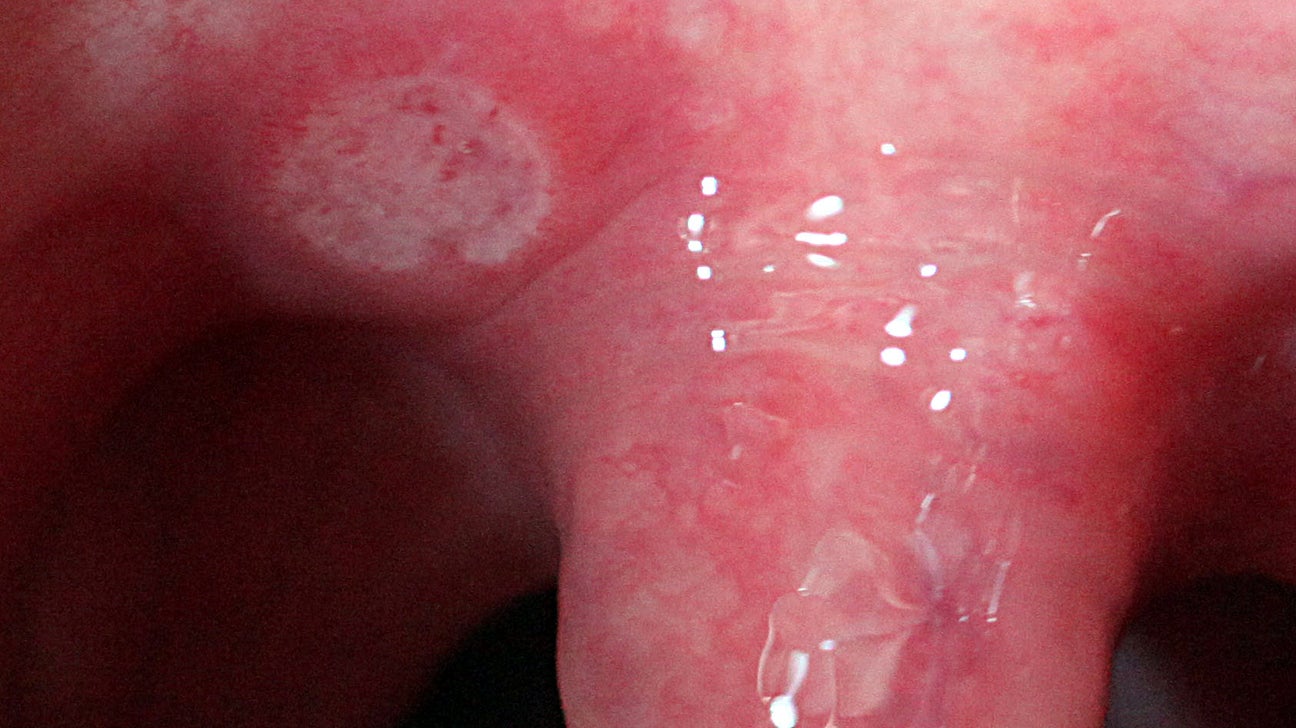 aphthous ulcers throat