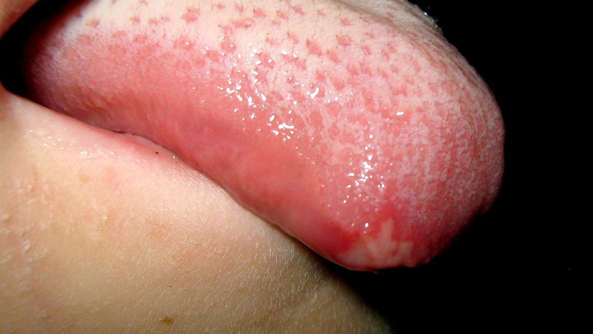 What does a canker sore look like on a tongue Canker Sore On Tongue Pictures Causes And Treatments