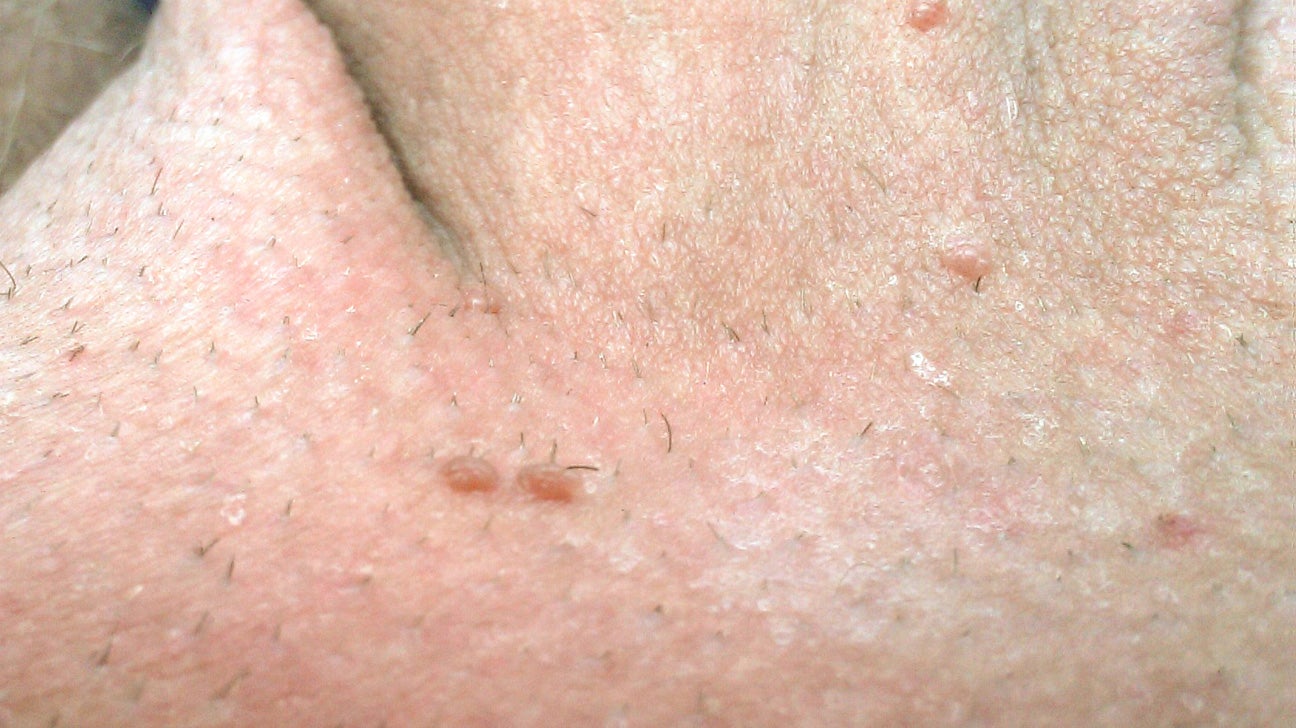 hpv wart color