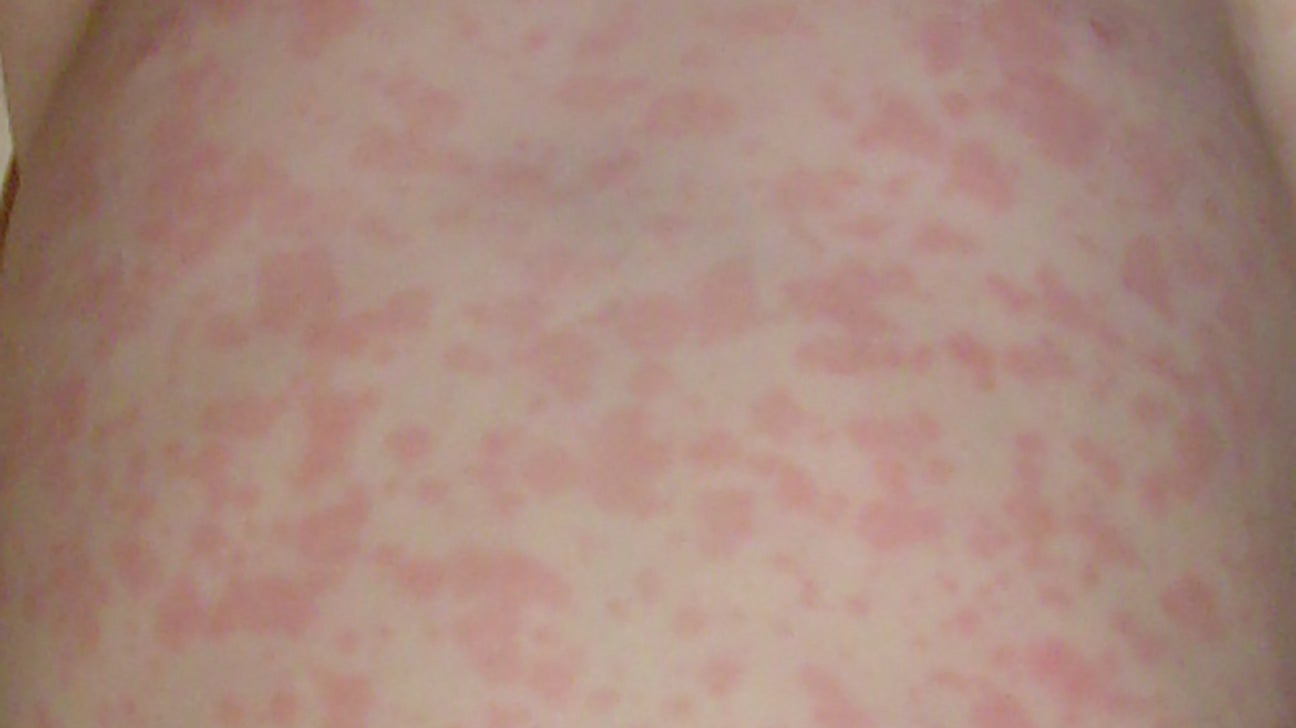 ebv rash amoxicillin