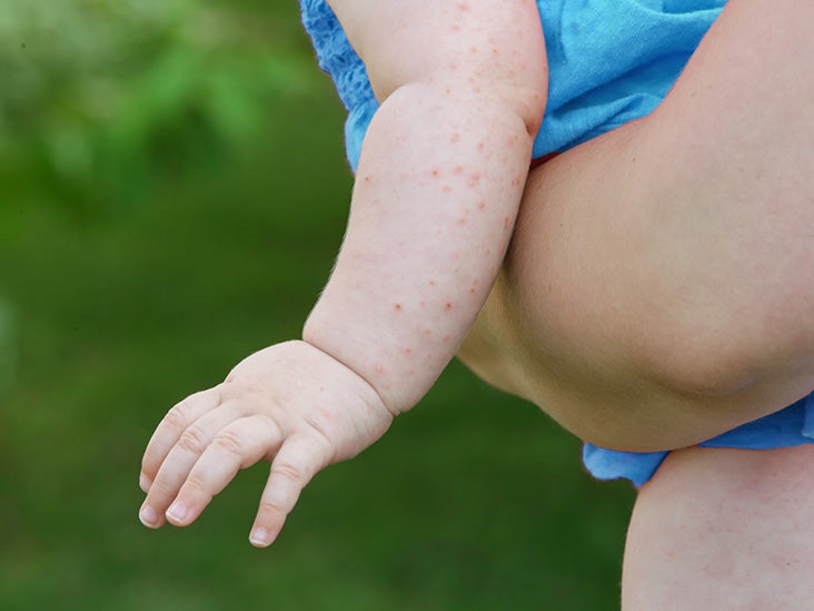 Baby Has Rash On Face After Fever