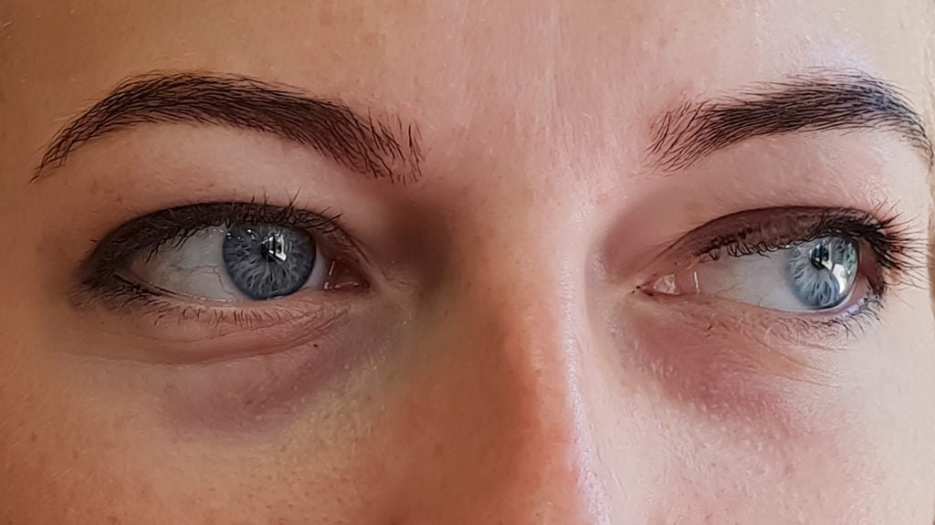 Swollen eyes - Reason and how to prevent them