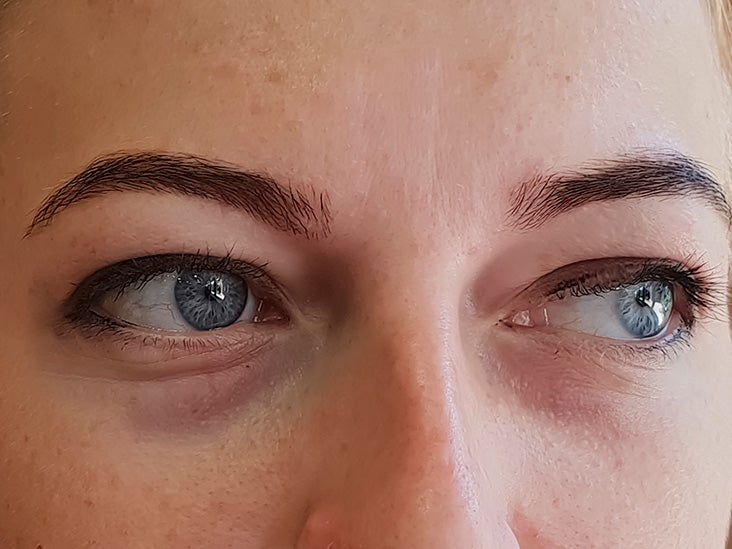 In most cases, fluid retention in the tissue around the eyes causes swelling or puffiness, which can occur due to crying or sleep. Learn more here.