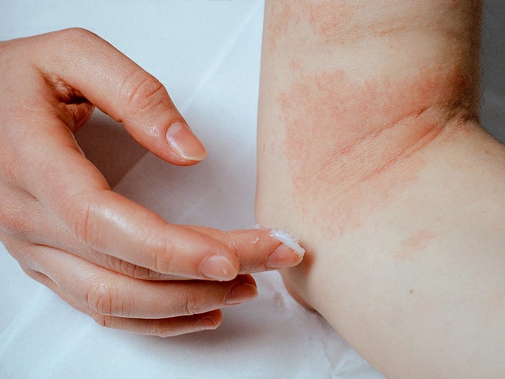 atopic dermatitis signs and symptoms piros folt jelent meg a gyomorfotón