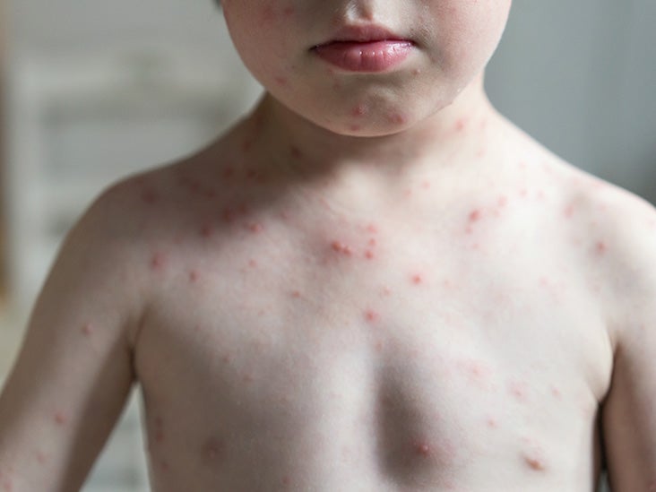 Can a toddler get a rash with a cold