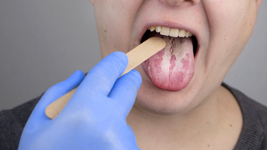 Yeast Infection In Mouth Causes Treatment And Prevention