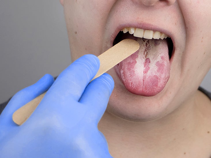 images-of-yeast-infection-in-mouth-yeast-infection-of-the-mouth