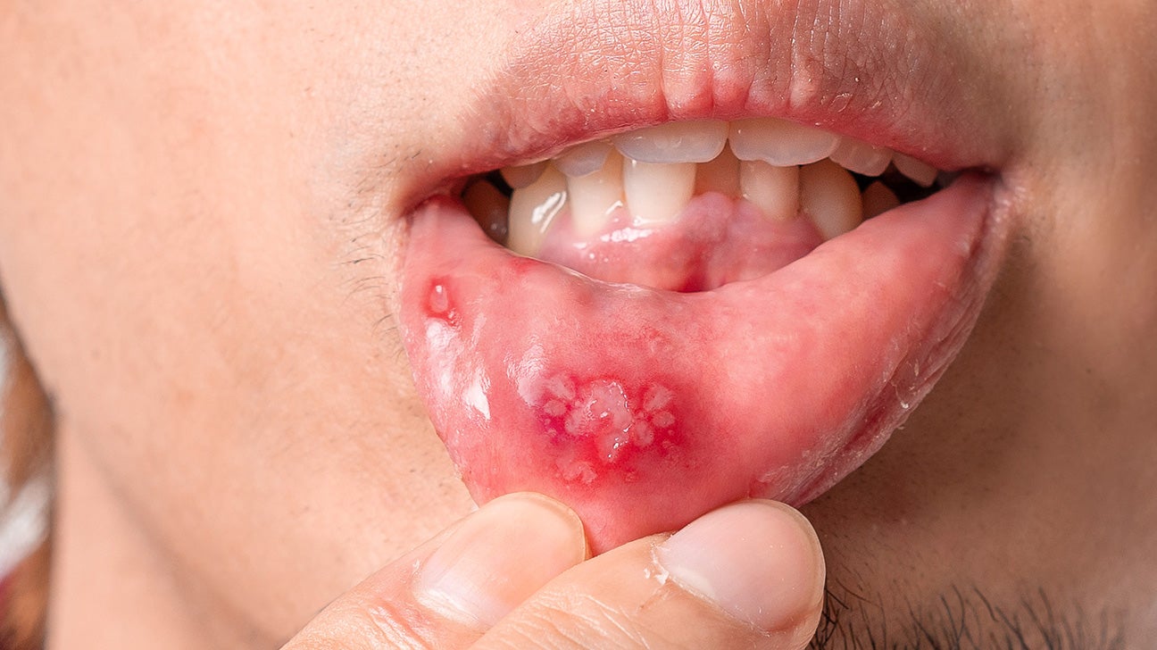 Canker sore on lip: Causes, risk factors, and treatment