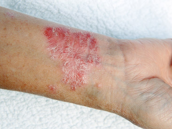 red-circle-on-the-skin-but-not-ringworm-other-causes