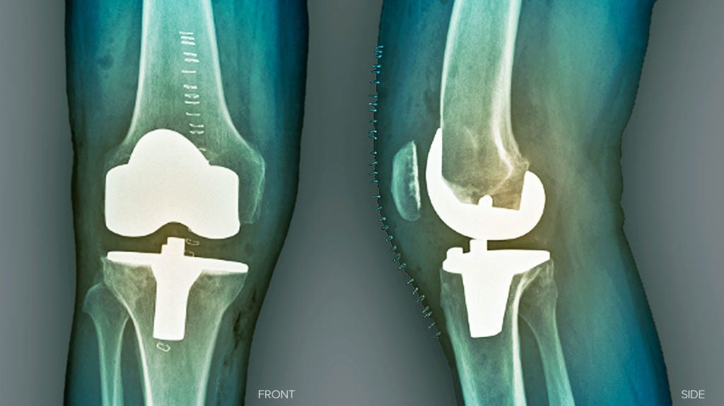 Knee Replacement Pain Management And When To See A Doctor
