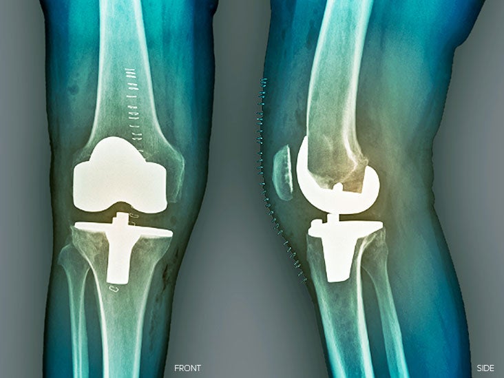 partial-or-total-knee-replacement-understanding-the-differences