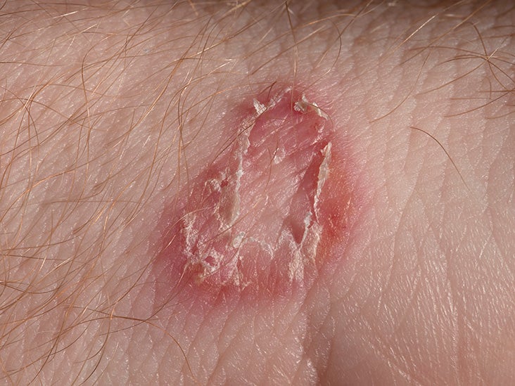 Red Skin Lesions On Hand at Ed McClean blog