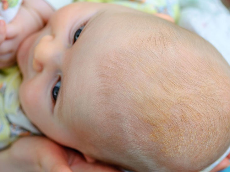 dandruff in 4 months old baby