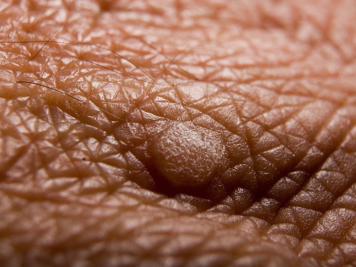 black warts on hands