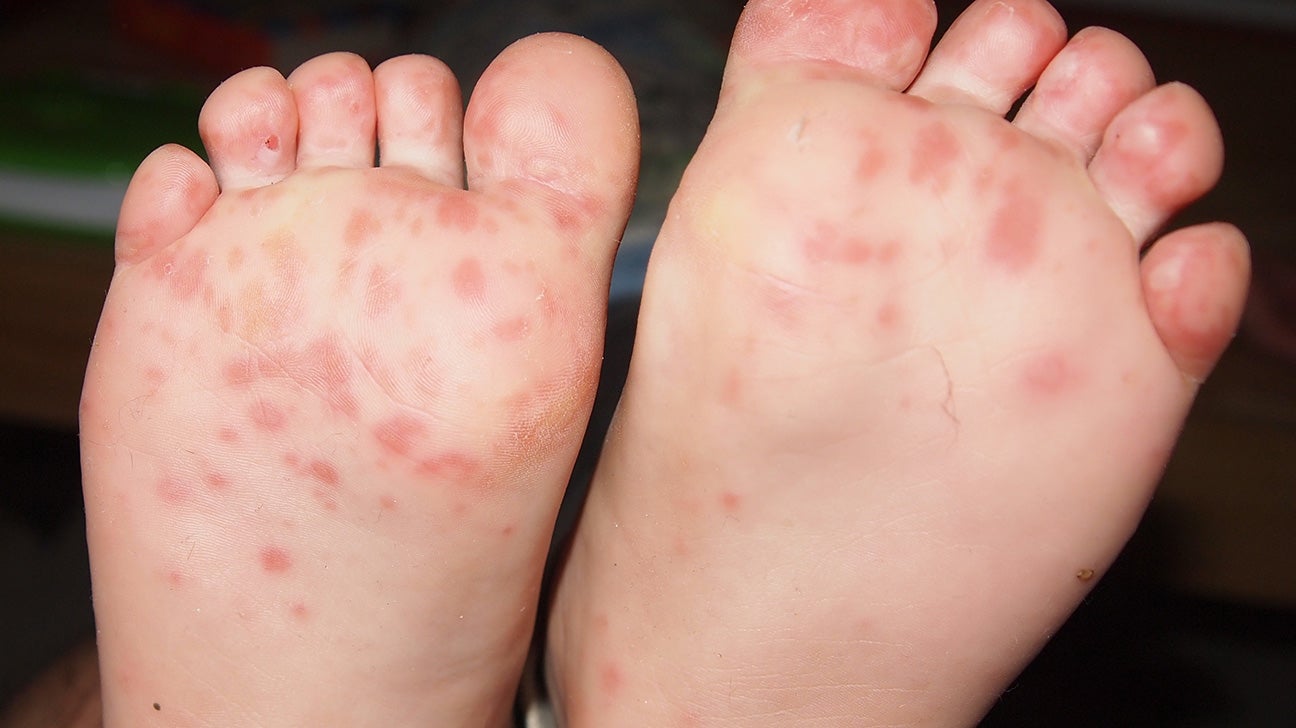 red sore soles of feet