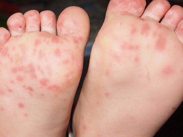 heat rash on hands and feet