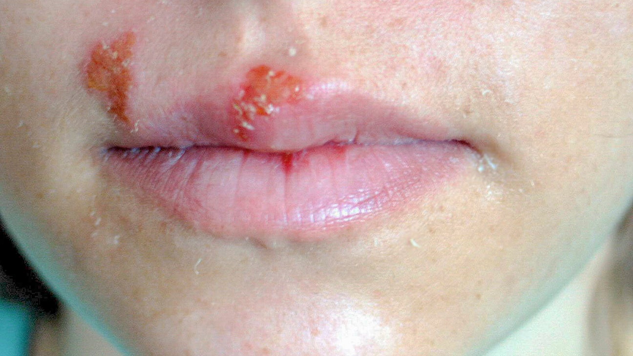 Cold Sores On Lips Early Stages 