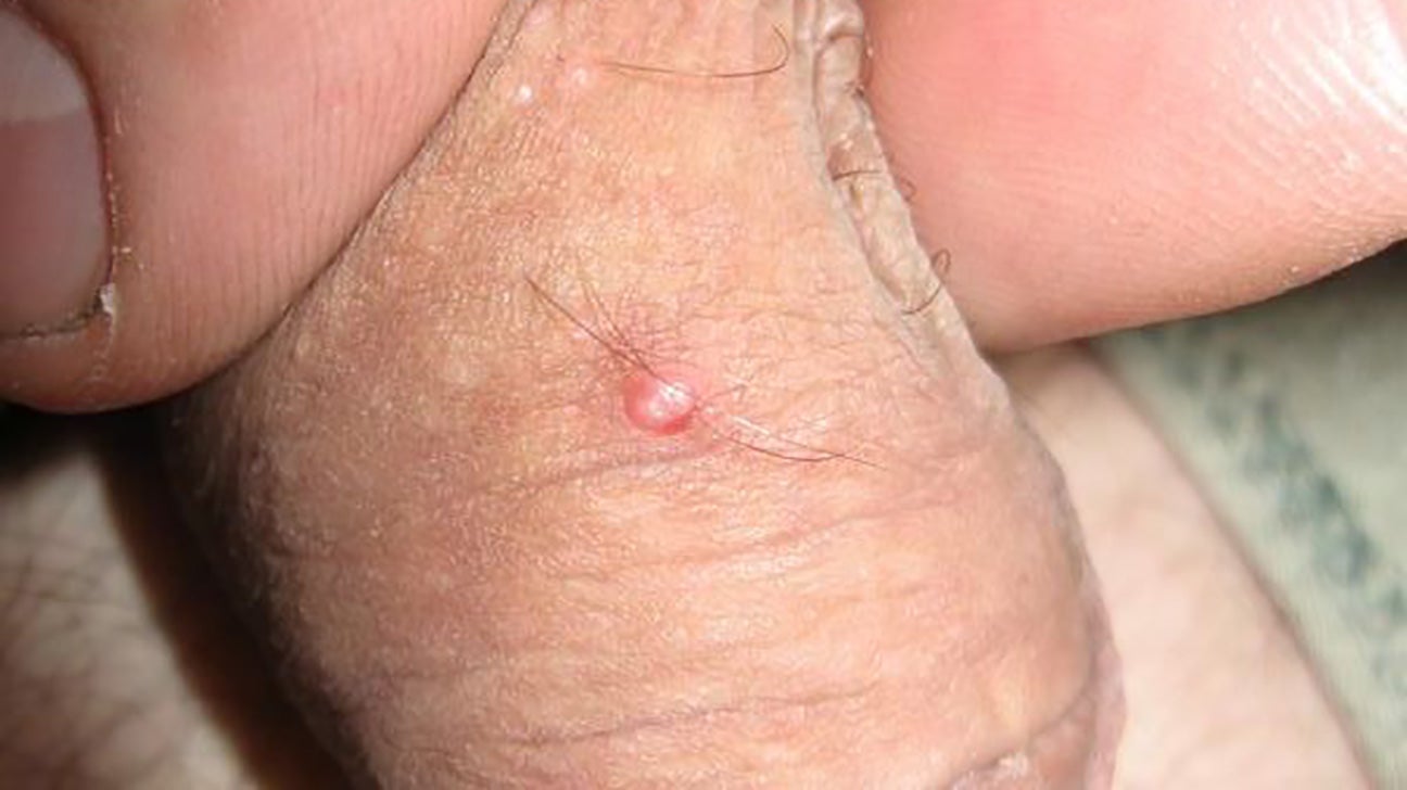 Slight rash on penis.