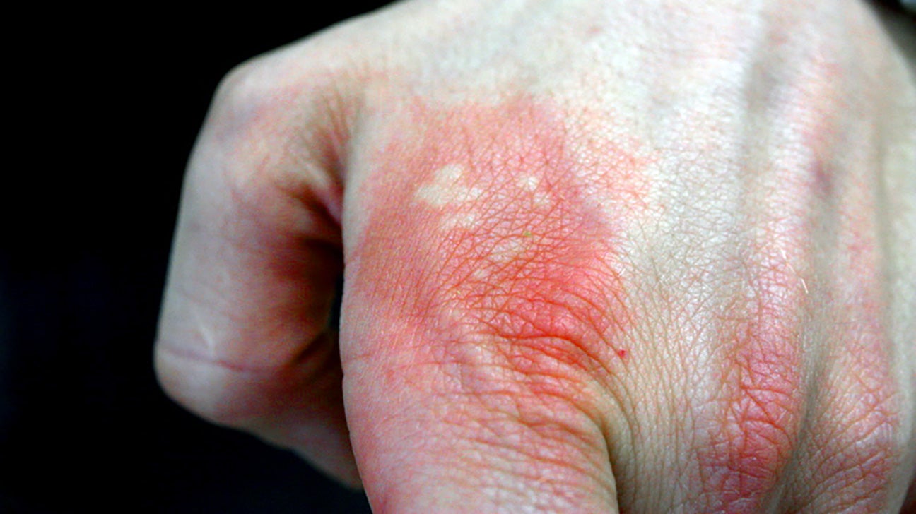 Stinging nettle rash Symptoms and treatments