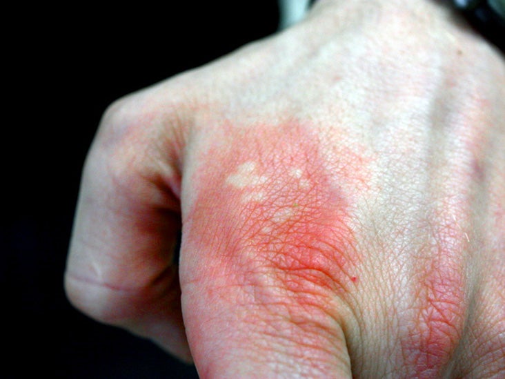 Stinging Nettle Rash Symptoms And Treatments