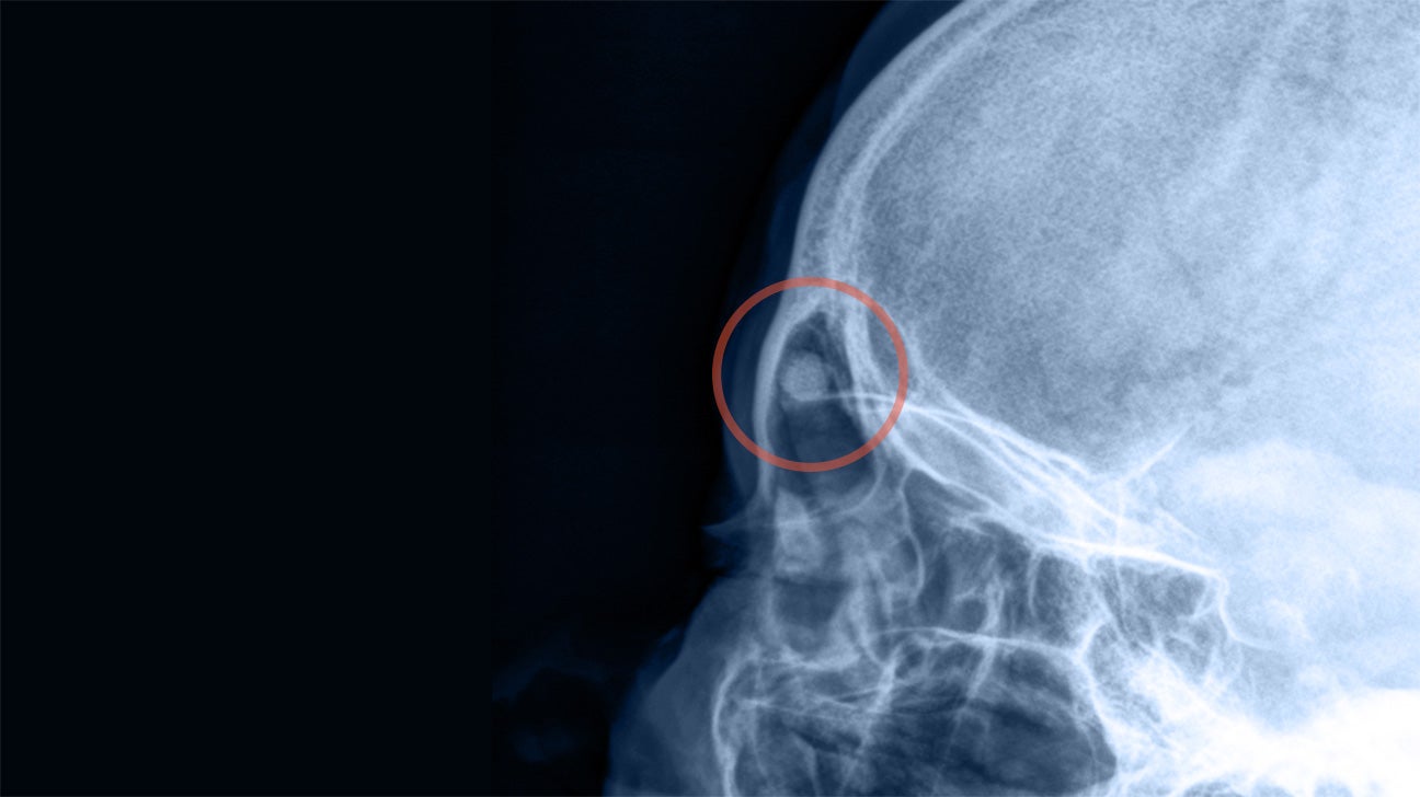 Osteoma Causes Treatment Removal Diagnosis And Outlook