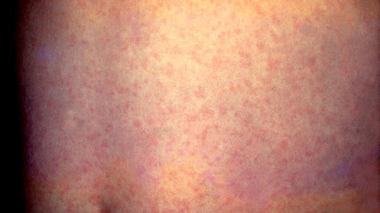 Toddler rash but not itchy