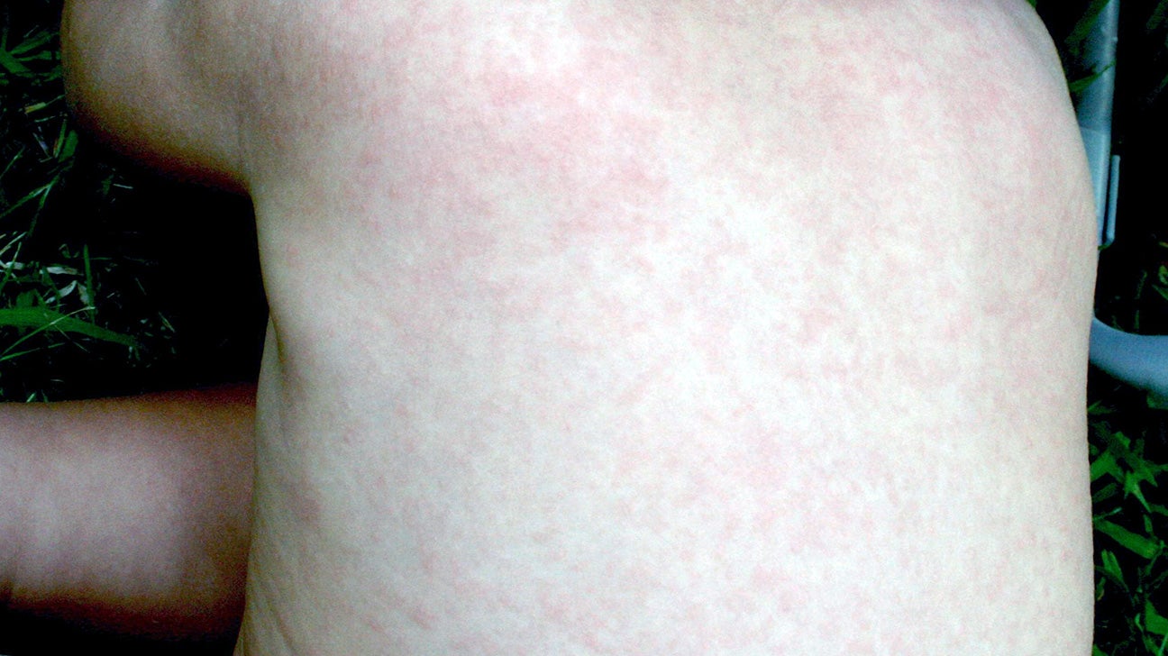 erythema subitum