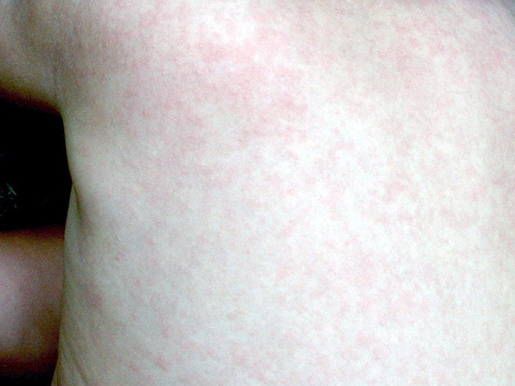 Fever With Rash In Child Pictures Causes And Treatments