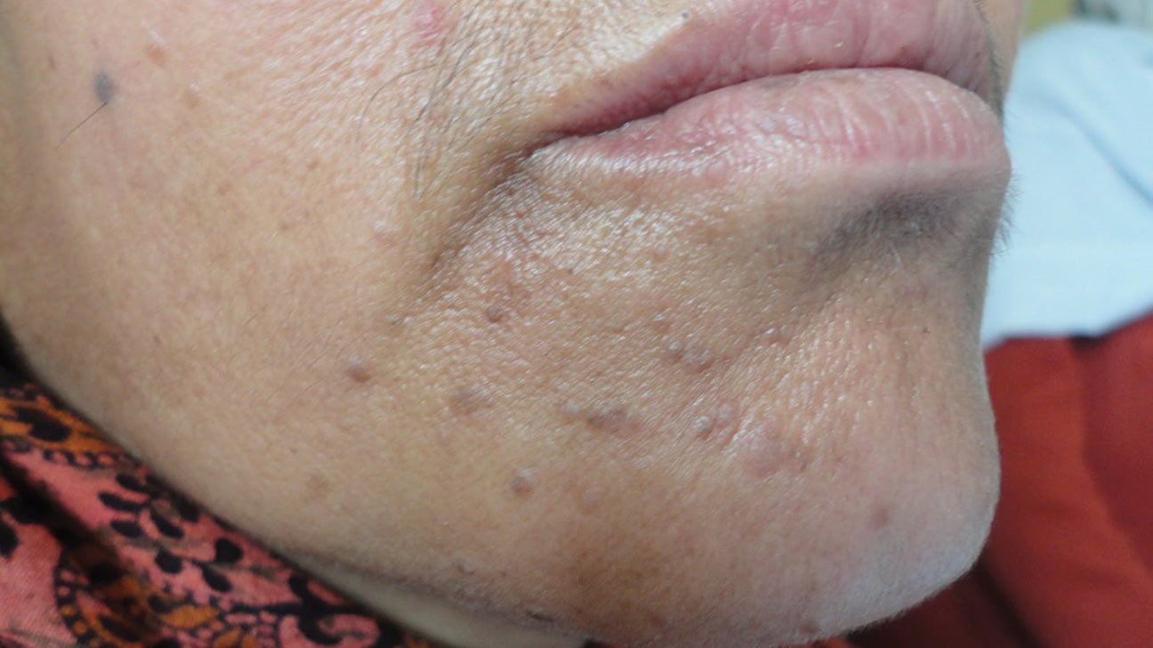 Hpv on face symptoms, Human papillomavirus skin rash. Hpv on the skin rash