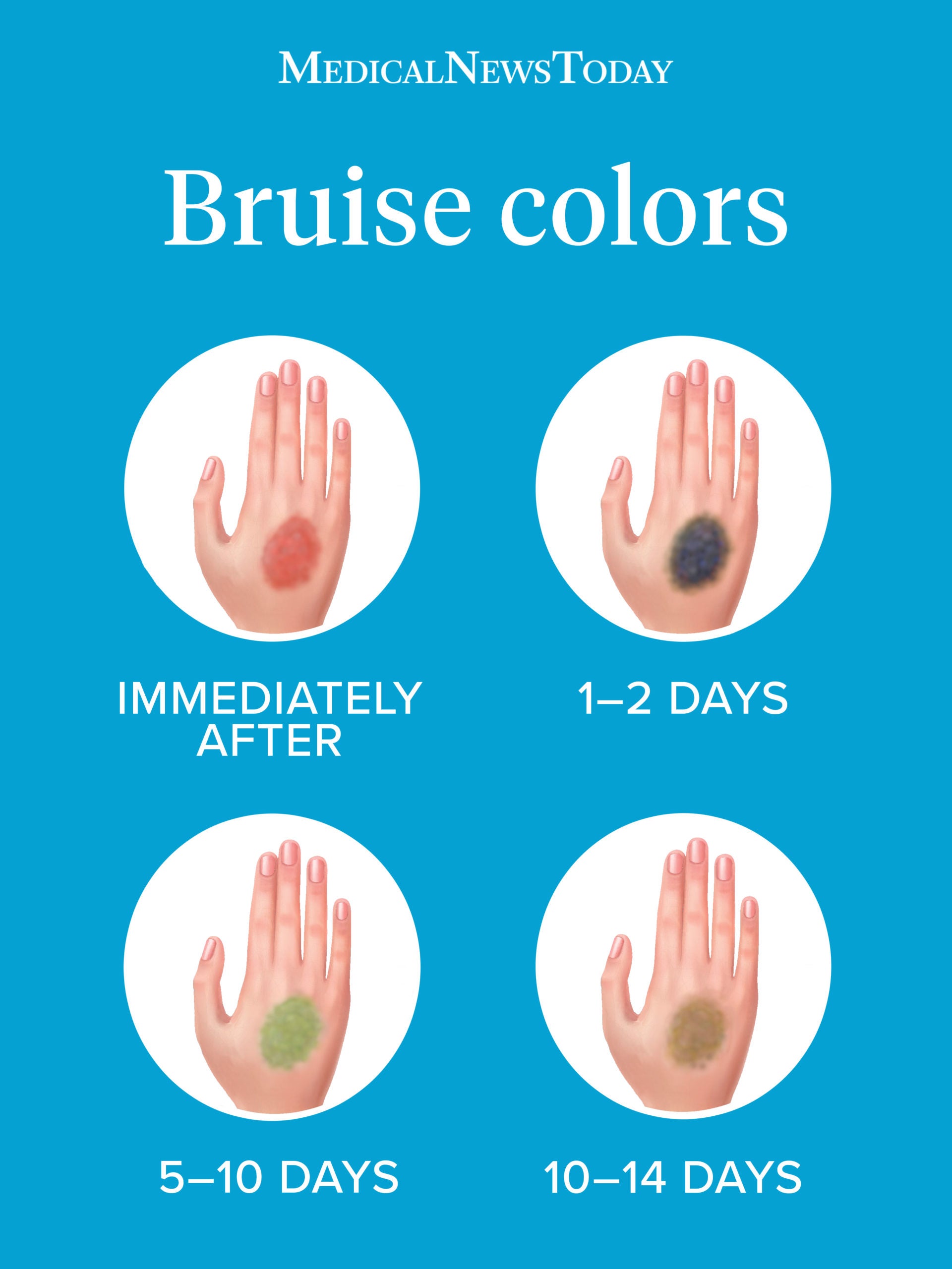 Bruise colors: Causes, timescale, and when to see a doctor